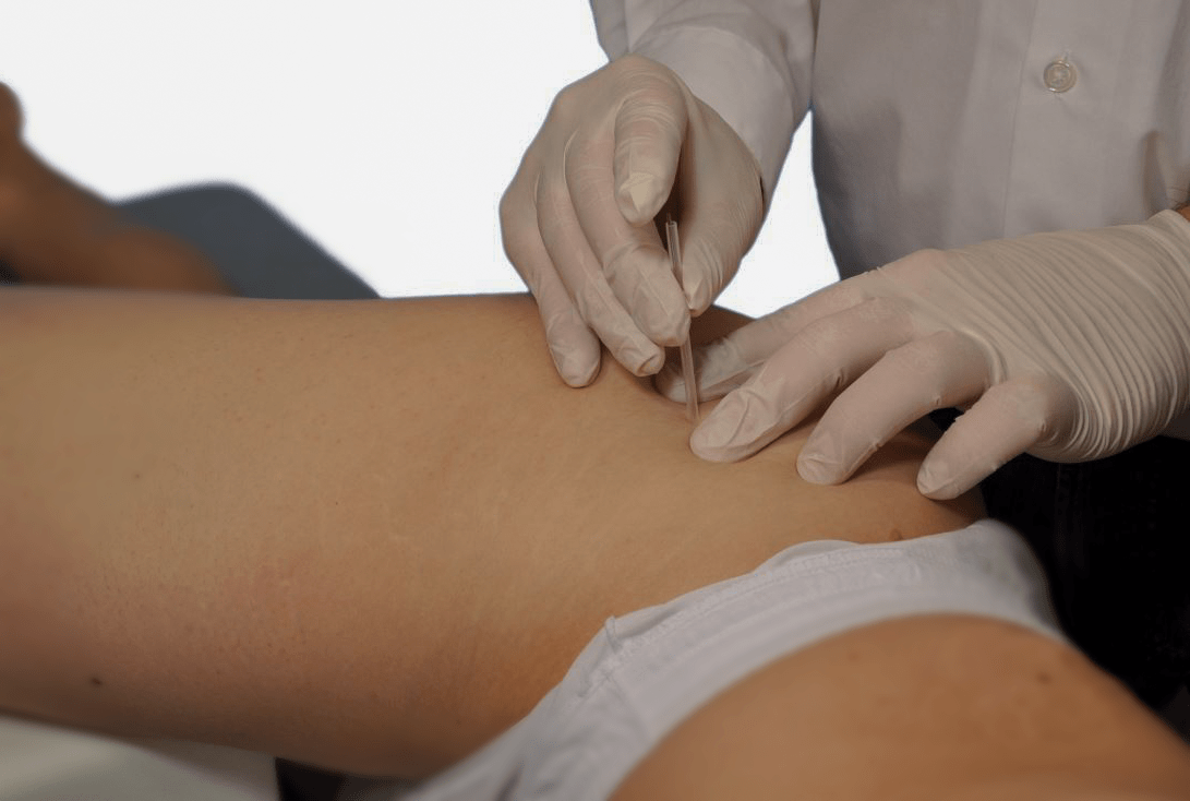 Glutaeus_Dry needling