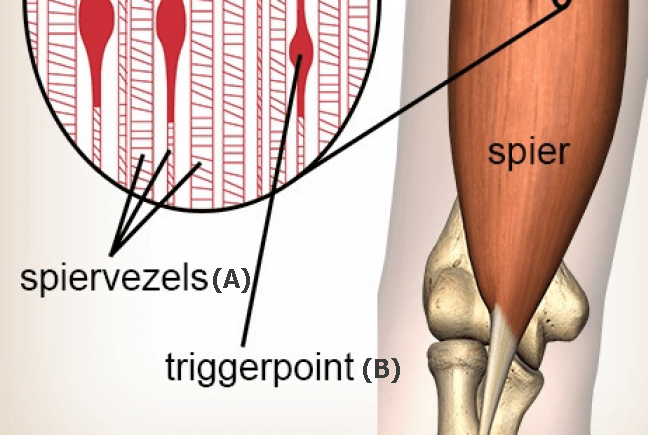 Dry-needling-triggerpoints-700x435-1